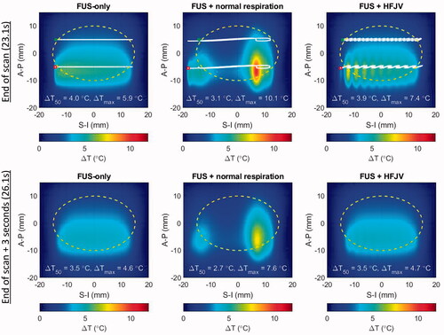 Figure 11. Temperature elevations for patient model M1 after a full slice moving beam scan (upper row) and 3 s after the end of the scan (lower row). left: no respiratory motion, center: normal respiratory motion, right: HFJV. In each panel, the coordinate system is referenced to the pancreas target center, the white line indicates the net trajectory of the HIFU beam, and the yellow dashed line encircles the treatment ‘slice’. The trajectory start and end points for the full slice treatment are indicated with green and red marks, respectively.