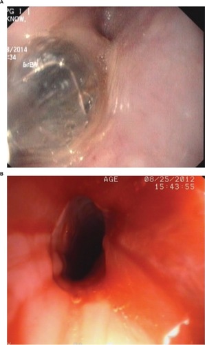 Figure 5 Endoscopic view of upper esophagus showing (A) balloon dilatation of web, and (B) fresh blood and remnants of circumferential web in the form of a rim after successful balloon dilatation.