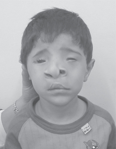 Figure 2 Case 1 at age 6 years. Note typical facial phenotype.