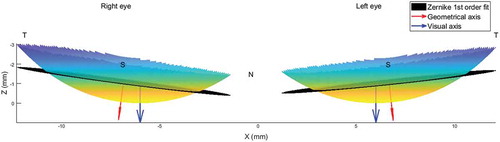 Figure 3. Determining corneal tilt by first-order Zernike polynomial fit (Same participant as in Figure 1b).