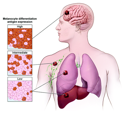 Figure 1. Melanoma differentiation antigen expression varies by anatomic site. Highest expression was observed in brain, intermediate expression in soft tissue and lymph node, and lowest expression in visceral (lung and liver) metastases.