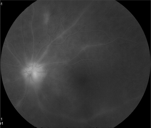 Figure 2. Late-phase fluorescein angiogram demonstrating optic disc hyperfluoresence and leakage of retinal arterioles and venules.