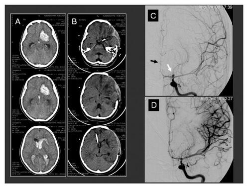 Figure 2 Eleven year-old child with H&H 5 SAH and clinical herniation signs; (A) Preoperative CT-scans demonstrating a left frontal mass occupying bleeding with intraventricular dissemination and acute hydrocephalus; (B) Postoperative CT-scans confirming the clot removal and the placement of the ventricular drainage. The borders of the decompressive craniotomy are well defined; (C) Preoperative cerebral angiography of the left internal carotid artery demonstrating the aneurysm (white arrow) and the caliber narrowing of the anterior cerebral artery (black arrow); (D) Postoperative, 10 hours later performed control angiography confirming the occlusion of the aneurysm and the improved cerebral perfusion.