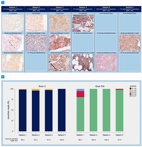 Figure 1. CD19 expression. (A) IHC data from serial core needle lymph node FFPE biopsies of six L-MIND patients; (B) CD19 exon skipping analysis from bulk RNA sequencing data from evaluable post-baseline samples. (A) Pre-tafasitamab and post-tafasitamab (during and after residual tafasitamab exposure) treatment. Shown are images (×400) after IHC staining of cytoplasmic CD19 epitope (anti-CD19 clone LE-CD19). Biopsies after tafasitamab discontinuation were categorized as taken within or after the timeframe of potential residual tafasitamab exposure (cut-off: five half-lives after last tafasitamab dose or 85 days (∼12 weeks)). Distinct CD19 expression can be observed despite any response-related selective pressure or presence of tafasitamab. Differences in staining intensity are considered to be caused by differences in sample quality. (B) Exon skipping was observed for exons 2 (E1–E3), 5 (E4–E6), and 5/6 (E4–E7). Frequency corresponds to the number of splice junction reads observed for each 3′-exon relative to total 5′-exon junction reads. The percentage of canonical E1–E2 and E4–E5 junction reads is provided for each patient. BOR: best objective response; FFPE: formalin-fixed paraffin-embedded; IHC: immunohistochemistry; PD: progressive disease; PR: partial response; SD: stable disease; W: week.