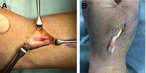 Figure 4 (A) Empty but normal 3d compartment (left), and (B) frayed tendon end (right).