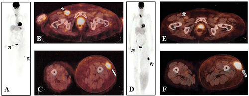 Figure 2 Mixed response after third line-therapy with ipilimumab. A baseline FDG-PET scan revealed progression of disease (A; black arrows), with evidence of a right inguinal lymph node (B; white star) and a left thigh subcutaneous lesion (C; white arrow). Tumor assessment performed at week 12 with FDG-PET scan showed a mixed response (D; black arrows), due to the regression of nodal disease (E; grey star) and the worsening of subcutaneous lesion (F; grey arrow).