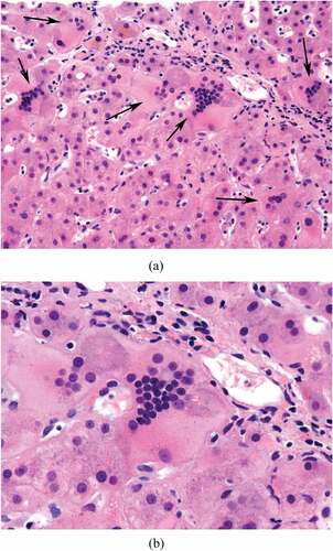 Figure 1. (a) Core liver biopsy specimen from Case 1 at low power (40x). Arrows indicate syncytial giant cell hepatocyte formation. (b) Core liver biopsy specimen from Case 1 at high power (100x).