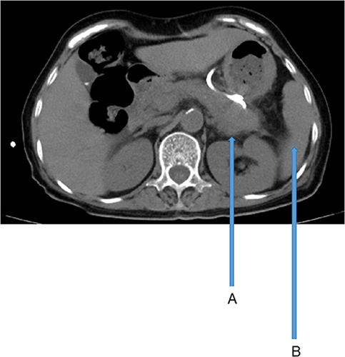 Figure 3 Abdominal CT scan at the time of discharge for this case. (A) The pancreas demonstrates an enlarged morphology with heterogeneous internal density. There are patchy areas of slightly lower density with indistinct borders. A local drainage tube has been implanted. (B) The spleen appears normal, with no apparent abnormalities in density.