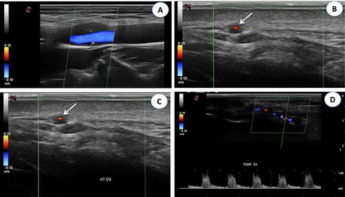 Figure 3 (A) Color Doppler ultrasonography (CDUS): longitudinal scan reveals a hypoechoic plaque in the proximal internal carotid artery. (B) CDUS of the right temporal artery shows a hypoechoic halo around the lumen in transverse view (arrow). (C) CDUS of the right temporal artery shows a hypoechoic halo around the lumen in transverse view (arrow). The halo sign corresponds to edema of the artery wall. (D) Longitudinal view of the right temporal artery by CDUS shows a hypoechoic halo of the temporal artery and the presence of turbulent and weak flow, suggesting the presence of stenosis. The peak systolic velocity is 1 m/s, that is double compared to the segment without stenosis.