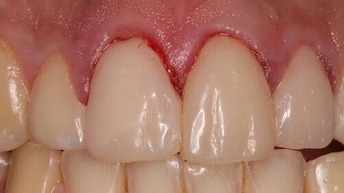 Figure 5 Intraoral mock-up.