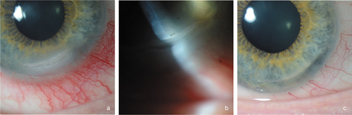 Figure 3. Slit-lamp biomicroscopy evaluation. (a,b) inferior peripheral crescent-shaped corneal ulcer with stromal thinning at presentation. (c) After one month of treatment, the epithelial defect was healed.