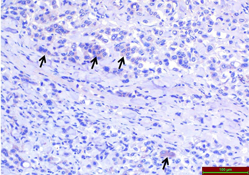Figure 3 Light microscopic examination of TRPA1 immunoreactivity immunohistochemical staining in High-Grade colon adenocarcinoma tissues. Arrows indicate areas of immunohistochemical staining.