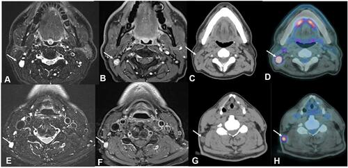 Figure 2 Male, 60 years old, cervical lymph node metastases (arrows) from a GBM. MRI axial T2-weighted sequences (A and E), MRI axial contrast-enhanced T1-weighted sequences (B and F), CT scans axial plane (C and G) and Fused Positron Emission Tomography- Computed Tomography axial plane (D and H). Observe the lymph nodes (arrows) in the right IIB (A–C) and V right level (E–G). Also, notice the increased uptake of fluorodeoxyglucose (FDG) in those lymph nodes (arrows in (D) and (H)).