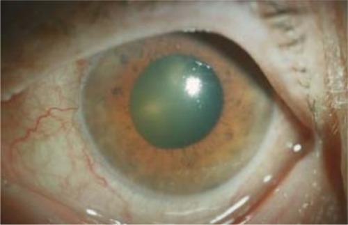 Figure 3 Acute angle closure glaucoma secondary to choroidal hemorrhage.