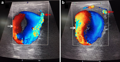 Figure 1 Color Doppler ultrasound images (a and b) showing the pseudoaneurysm fed by the internal carotid artery (red arrow) and a yin-yang pattern (white arrow).