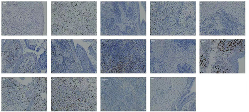 Figure 4 Immunohistochemical tests of nasal biopsy were negative. (A) EBER. (B) Ki-67. (C) CD19. (D) CD20. (E) TIA-1. (F) CD8. (G) CD3. (H) CD2. (I) CD56. (J) CD79a. (K) CD7. (L) CD4. (M) Granzyme B. (N) Pax-5.