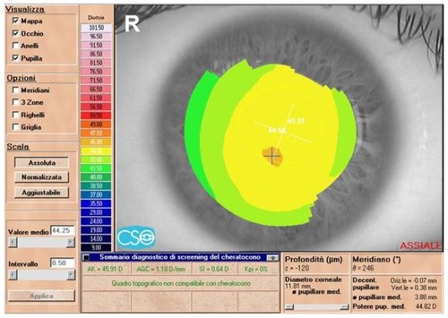 Figure 2 Preoperative topographic corneal map of a 22-year-old male patient (MG) in group 2 (Eye Top, CSO, absolute scale, axial map).