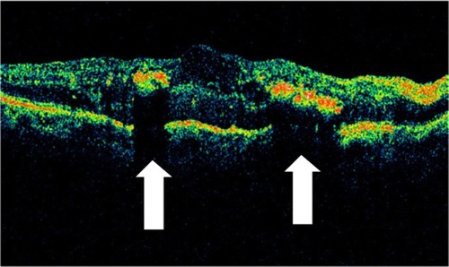 Figure 29 Stratus optical coherence tomography image.