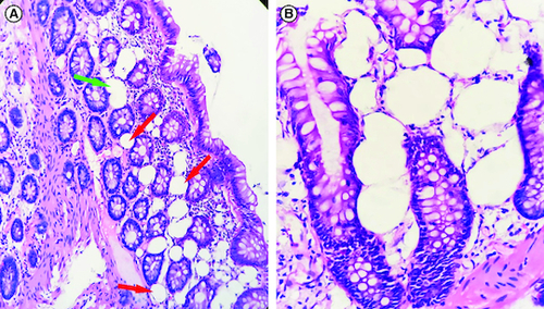 Figure 2. Histological examination.(A) Numerous optically empty vacuoles of variable sizes (red arrows) in the lamina propria and the muscularis mucosa, sometimes confluent (green arrow), intermingled with inflammatory cells (hematoxylin-eosin 200×). (B) The optically empty vacuoles repress and distort the cryptic contours (hematoxylin-eosin 400×).