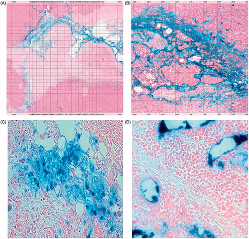 Figure 5. Histopathological images of Prussian blue-stained tissues. (A) Section of HepG2 tumour (2× magnification) harvested 3 days post-AMF–hyperthermia with BNF-lip showing necrotic cells in immediate vicinity of tumour evidenced by pale colouring, and localisation of BNF particles (blue) in the vicinity of the presumed needle track. (B) As in A, but at 8× magnification. (C) Section of liver VX2 tumour harvested at 7 days after intra-arterial injection with BNF-lip. Note that iron is deposited either in the tumour interstitium (C) and/or inside the tumour vessels (D).