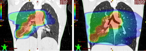 Figure 2. The increased lung volume in DIBH moved the targets apart, increasing MLD and V20 in DIBH (right) compared to the free breathing (left) from 23.1 Gy to 21.2 Gy and from 49% to 40%, respectively.