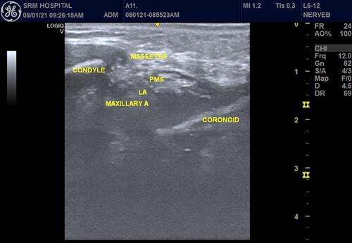 Figure 1 Ultrasound-guided mandibular nerve block.