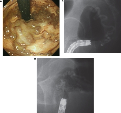 Figure 1 A) Cb, F2, RC-positive rectal varices. B) Fluoroscopic observation with infusion of 5% EOI was performed to determine the extent of the varices. C) One week after, fluoroscopic observation with infusion of 5% EOI.