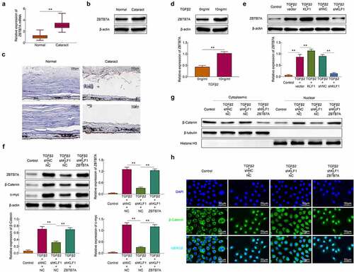 Figure 4. KLF1 activated the expression of ZBTB7A in human lens epithelial cells. (a, b) The expression of ZBTB7A in lens capsule tissues detected by RT-PCR and western blotting. (c) The expression of ZBTB7A in lens capsule tissues detected by immunohistochemical staining. (d, e) The expression of ZBTB7A in human lens epithelial cells detected by western blotting. (f) The expression of β-catenin, c-myc and ZBTB7A in human lens epithelial cells was determined with the western blotting. (g) The expression of β-catenin in nucleus and cytoplasm of human lens epithelial cells was determined with the western blotting. (h) The expression of β-catenin in human lens epithelial cells detected by immunofluorescence. * p < 0.05, ** p < 0.01, *** p < 0.001