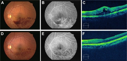 Figure 3 Clinical findings before and after surgery.