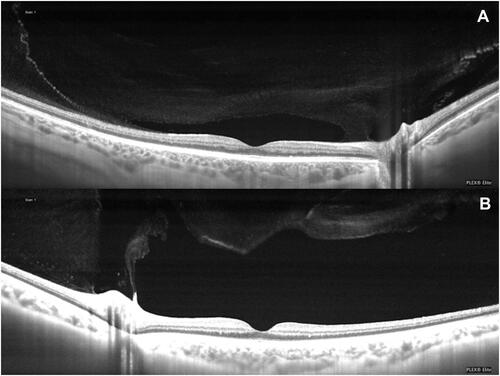 Figure 1 (A and B) No complete posterior vitreous detachment (PVD) identified by Swept Source Optical Coherence Tomography (SS-OCT). (A) The premacular bursa is visible, and the vitreous remains attached temporally and at the optic nerve head. (B) The vitreous is detached temporally and at the fovea but remains adherent to the optic nerve head.