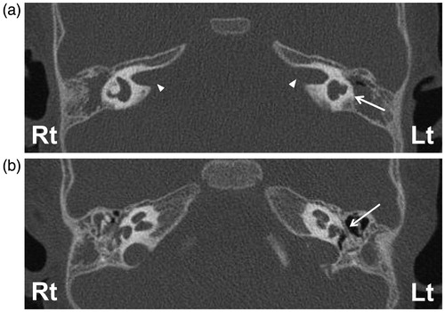 Figure 3. (a) High-resolution computed tomography (HRCT) demonstrated bilateral hypoplasia of semicircular canals (especially, the left side was like a sac formation), (arrow). (b) Axial HRCT shows the fallopian canal on the right side is normal, but on the left side the tympanic segment is very narrow (arrow).