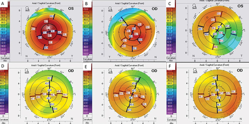 Figure 1. (a-f): Corneal topography of the contralateral eye of the patients; a- Patient 1, b-Patient 2, c-Patient 3, d-Patient 4, e-Patient-6, f-Patient 7 (Patient 5 with Down’s syndrome could not cooperate for topography).