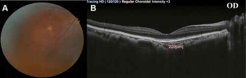 Figure 1 A 32-year-old female with two years duration of illness, (A) fundus photography revealing a hypopigmented lesion detected in the lower nasal quadrant of the right eye, and (B) SFCT measurement using SD-OCT in the right eye.