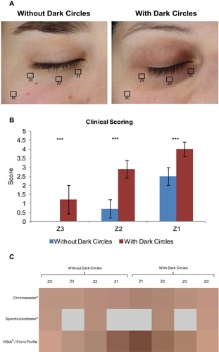 Figure 1 (A) Images captured with the VISIA-CR of subjects with and without dark circles, showing the position of the infraorbital zones and the control zone on the cheek. (B) Clinical scoring of dark circle intensity in the three zones under the eye. (N =12 with dark circles versus N=12 without dark circles, ***p<0.001). (C) Comparison of the mean colorimetric data (L* a* b* CIELAB 1976) assessed with Chromameter, Spectrocolorimeter and VISIA image processing. (Grey = measurement not taken).