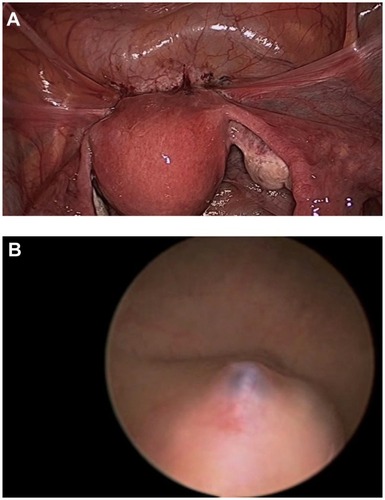 Figure 5 (A) Endometriosis visible on the vesicouterine fold. (B) The same bladder on cystoscopy demonstrated endometriosis infiltrating the bladder mucosa.