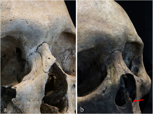 Fig. 1 Cranial non-metric traits in the nasal region are often used in ancestry estimation. These two crania illustrate variance in nasal bone contour: a) steepled, almost triangular, contour is more typical in individuals of European ancestry; b) low, rounded nasal bones are more frequently found in people of African ancestry; this individual, however, also has a pronounced nasal spine (red arrow) that is more common in European populations.