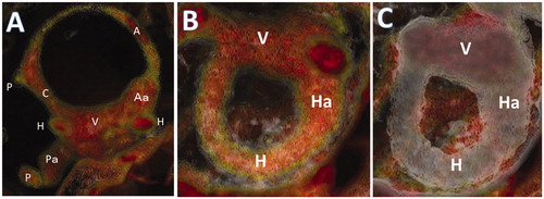 Figure 2. Representative 3DCT images of the utricle and semicircular canal. (A) Vestibule and semicircular canal. (B) HC with CTWVs of endolymph (red color) and OS (yellow color) at through arc view. (C) Recognition of HC with its through arc view. Shadow shows cutting face. A: anterior canal; Aa: ampulla of anterior canal; C: common crus; CTWV: CT window value; H, HC: horizontal canal; Ha: ampulla of horizontal canal; OS: otoconia-like substance; P: posterior canal; Pa: ampulla of posterior canal; V: vestibule.