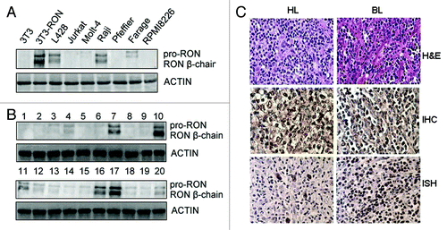 Figure 1. RON is highly expressed in Burkitt’s lymphoma (BL) and Hodgkin’s lymphoma (HL) tissues and cells. (A) Western blots show RON expression in various human leukemia/lymphoma cell lines. Cellular protein samples (50 µg) were subjected to western blot analysis using rabbit immunoglobulin G to the RON C-terminus (R5029). 3T3-RON cells were used as positive controls. Actin served as a loading control. (B) RON expression in clinical samples was detected by western blot analysis. Lane 7, Burkitt’s lymphoma specimen; lanes 10 and 17, 3T3-RON cells; lanes 11 and 16, Hodgkin’s lymphoma specimens. (C) RON immunostaining and EBV in situ hybridization (ISH) in BL and HL lymphoma tissues. Upper panel, cases in which routine histological diagnosis was determined by H&E staining; middle panel, representative RON immunohistochemical (IHC) staining of BL and HL tissue samples; bottom panel, strong nuclear EBV ISH in BL and HL samples by EBER. Images were obtained using a BK40 Olympus microscope (magnification, ×40).