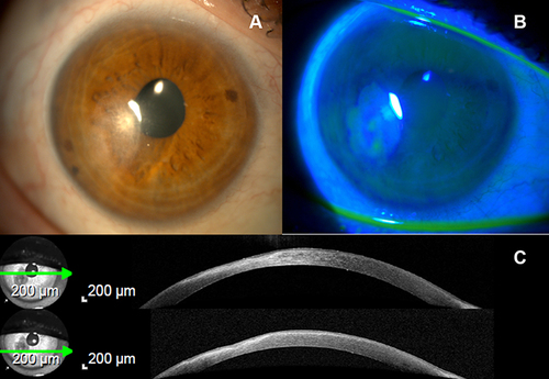 Figure 3 (A) – Slit-lamp image with visualization of a paracentral leukoma; (B) – Leukoma that no longer is stained with fluorescein; (C) - Corneal-OCT demonstrates an improvement in stromal organization – the green arrows under the caption on this figure (on the left) correspond to the cornea that is expressed in all its extension and by layers in Figure 1C (on the right).