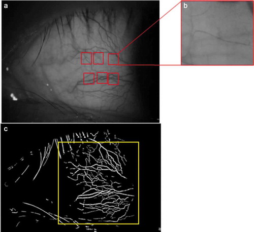 Figure 1. (a) Images of paranasal bulbar conjunctival microvascular network with 16× magnification. (b) One of the six regions of view of 1.20 × 0.90 mm2 to capture the movements of red blood cell clusters. (c) The fractal analysis, including D0 and Dbox, was obtained in the blue area, approximately 15.24 × 10.16 mm2