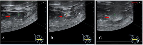 Figure 2. Changes of FA lesions treated with FUAS under real-time ultrasound monitoring. (A) Before treatment. (B) Hyperechoic scale changes occurred in the lesion during treatment. (C) Hyperechoic scale changed area covered the whole FA.