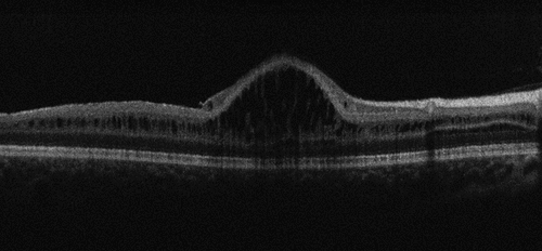 Figure 4. Optical coherence tomography (OCT) image of a 7-year-old patient with XLRS due to an RS1 mutation. Image courtesy of Dr Jonathan Ruddle, Melbourne Children’s Eye Clinic.