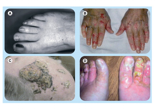 Figure 4. Examples of cutaneous complications with hydroxycarbamide therapy.(A) Hyperpigmentation of the lunula, (B) erythematous scaly flat papules over dorsal aspect of the hands, (C) cutaneous squamous cell carcinoma and (D) cutaneous ulceration of the toes.