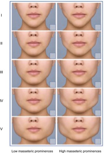 Figure 1 Ten-point photonumeric masseter prominence rating scale for females.