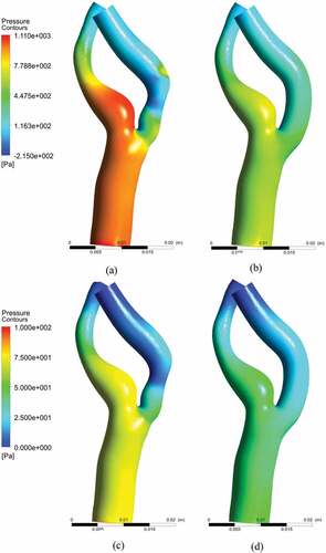 Figure 12. Pressure distribution: (a) near peak systole stenosed model, (b) near peak systole stented model (c) peak diastole stenosed model, (d) peak diastole stented model.