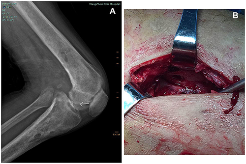 Figure 1 (A) Diffuse low-density transparent areas can be seen in the lower part of the left femur and the upper part of the tibia. The boundary is unclear. The density of the patella is slightly uneven. The joint surface of the patella is narrow and rough, and the joint space is narrow. No abnormalities are found in the surrounding soft tissues. (B) Bone destruction is observed at up to a depth of approximately 2 cm inside the tibial tubercle, reaching deep into the medullary cavity.