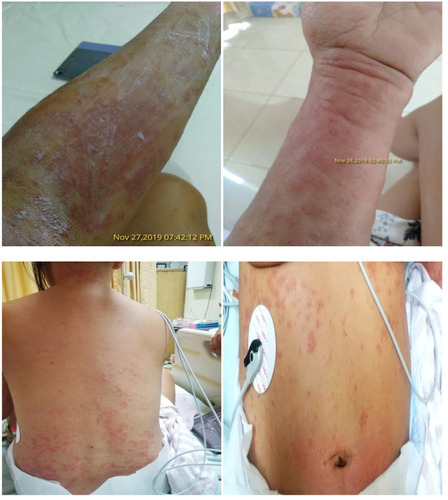 Figure 3 Generalized itchy rash lesions (full blown).