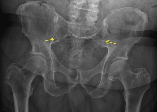 Figure 8 Anterior-posterior radiograph of pelvis showing joint space narrowing, some subcortical sclerotic changes (yellow arrows), anterior sacral osteophyte formation, and joint surface irregularity which is seen in osteoarthritis of the SIJ.