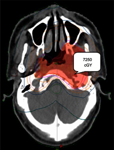 Figure 2 A dosimetric map around the encased carotid artery.