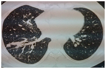 Figure 2 Computed tomography scan of the chest, revealing a right lung consolidation, with bronchogram, of the anterior segment of the lower lobe.